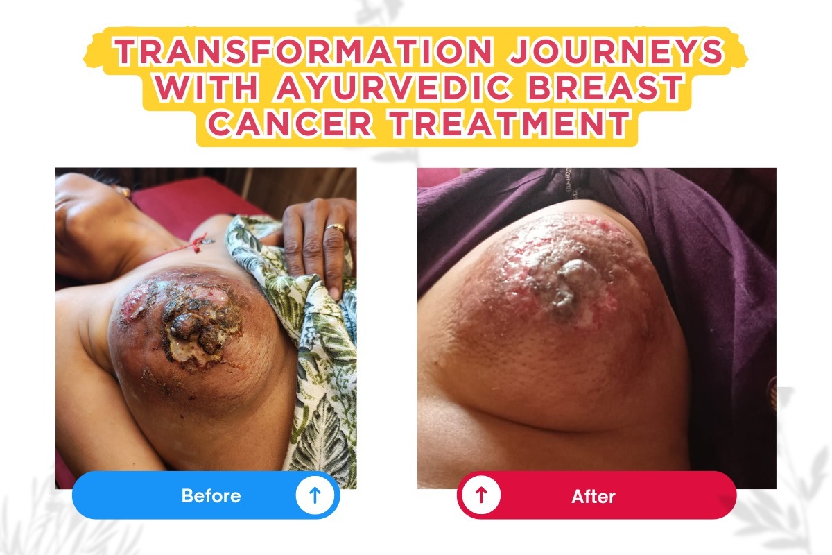 Before & After: Transformation Journeys with Ayurvedic Breast Cancer Treatment